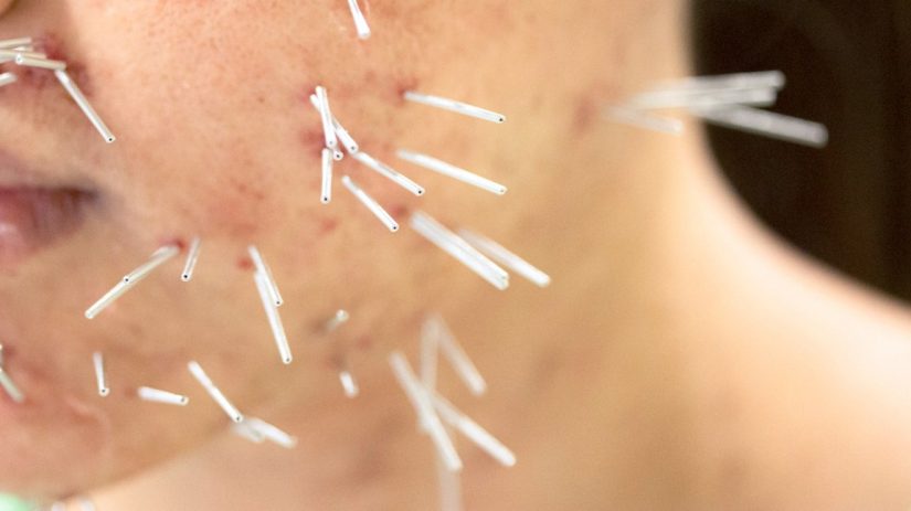 How to Find the Best Acupuncture Melbourne