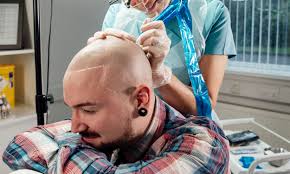 Scalp Micropigmentation is a Cosmetic Surgery That is Safe