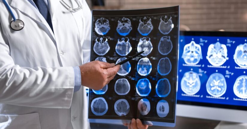 Expert Treatments from a Neurologist in Melbourne