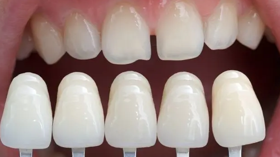 Top Benefits of Dental Veneers in Newtown