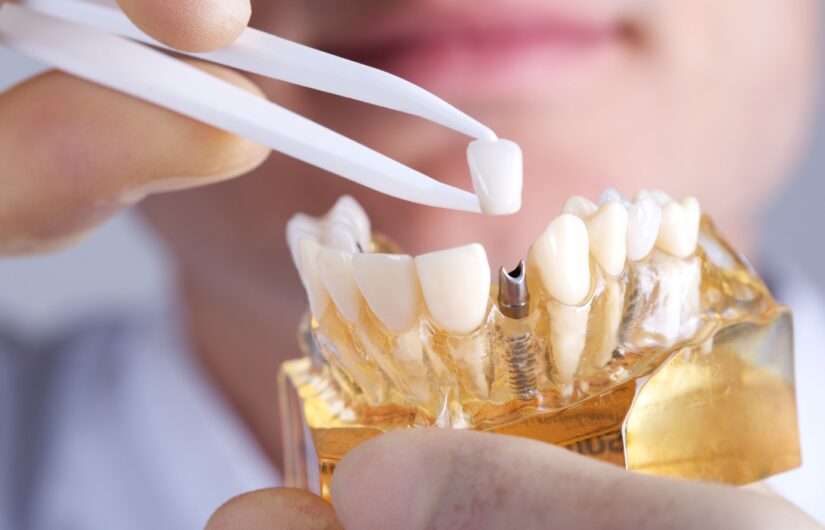 Why Dental Implants Paddington Improve Oral Health